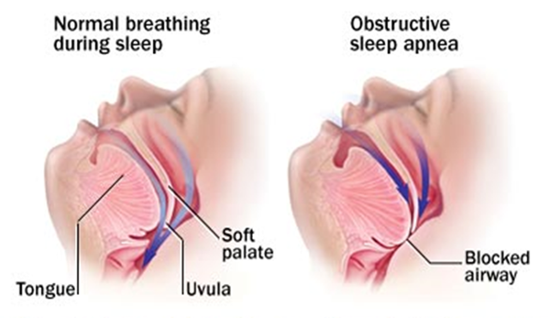 obstructive sleep apnea